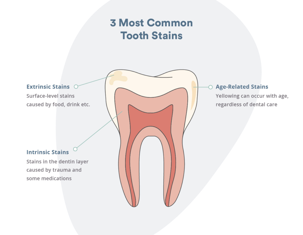 Common tooth stains