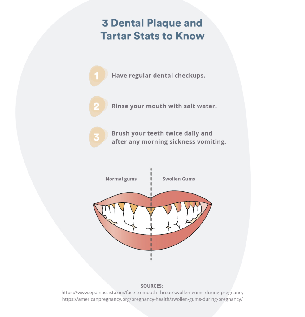 Dental plaque and tartar: why you should go to the dentist