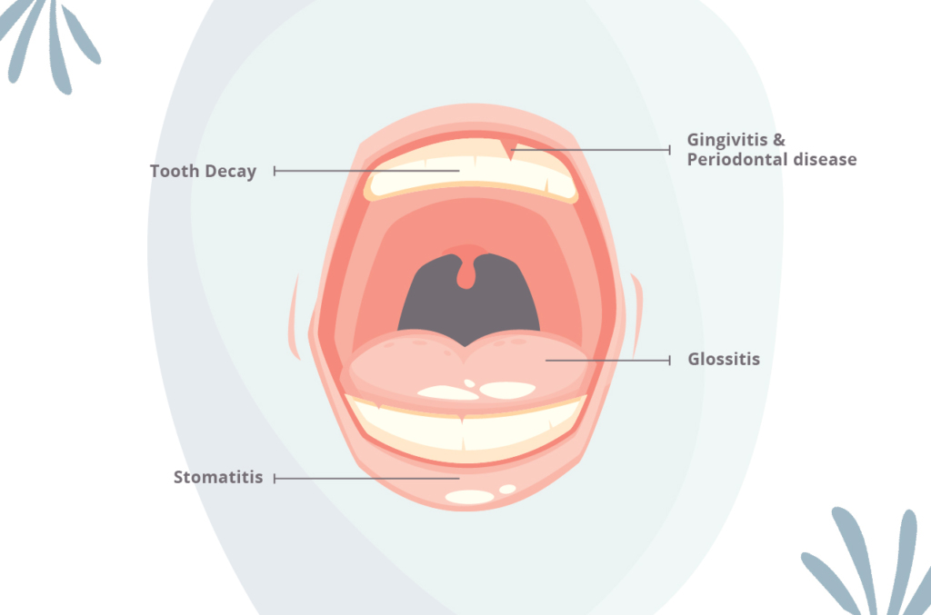 what tartar and plaque lead to