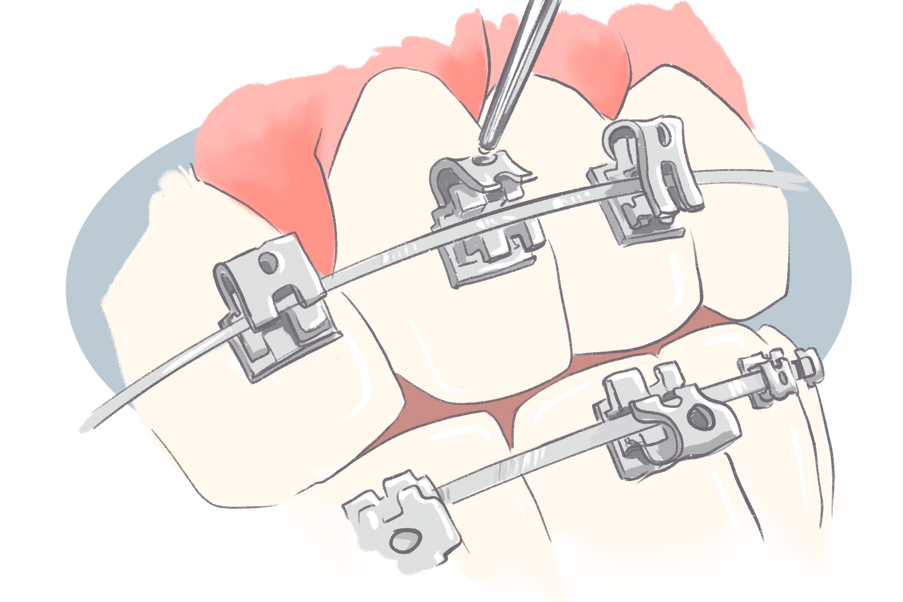 self litigating braces