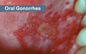 gonorrhea std
