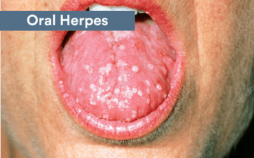 how long does it take for herpes to show up