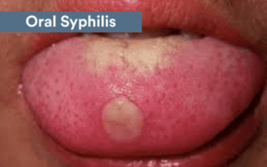 chlamydia mouth sores