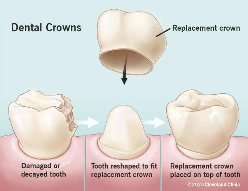 Dental crowns procedure