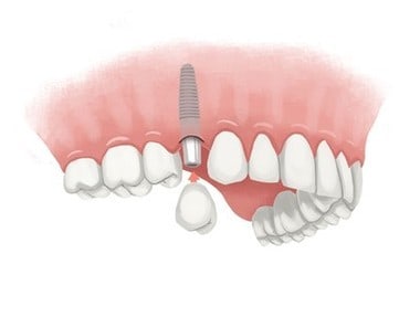 How much do mini dental implants cost