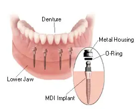 Parts and cost of mini dental implant