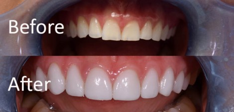 Veneers Vs. Dental Crowns: Comparison And How To Choose The Best Option ...