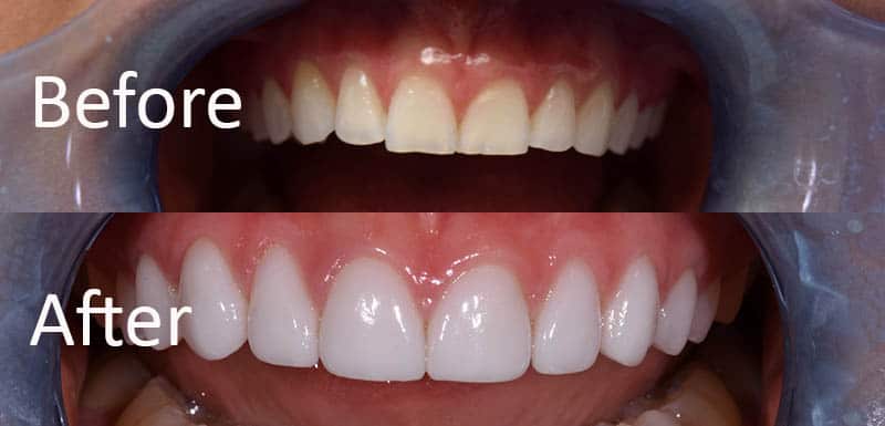 Veneers vs. Crowns: What to Know