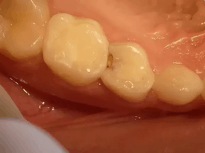 what do cavities look like before the treatment