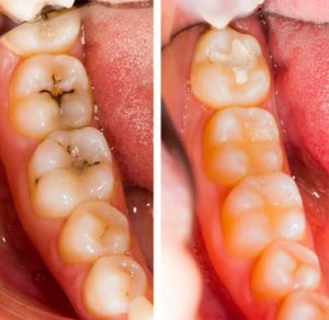 Dental fillings before and after