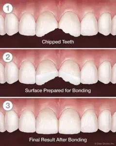 Tooth bonding process: Before and After