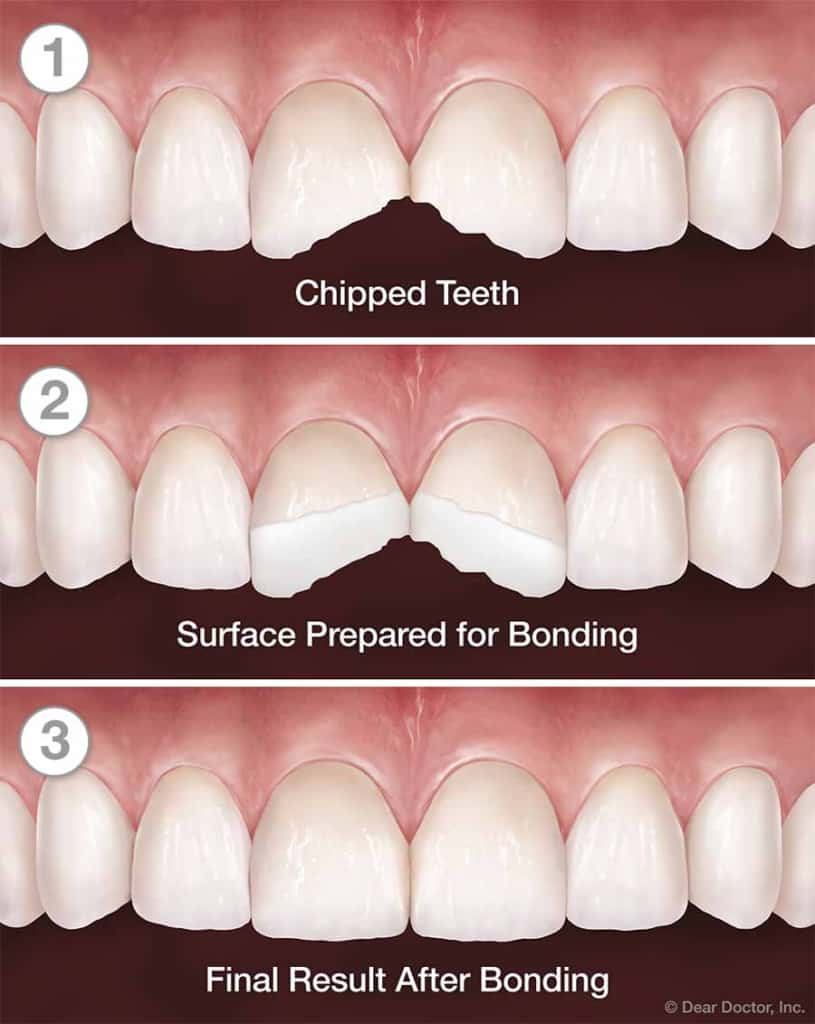 Best Dental Bonding Agent 2020 at William Miller blog