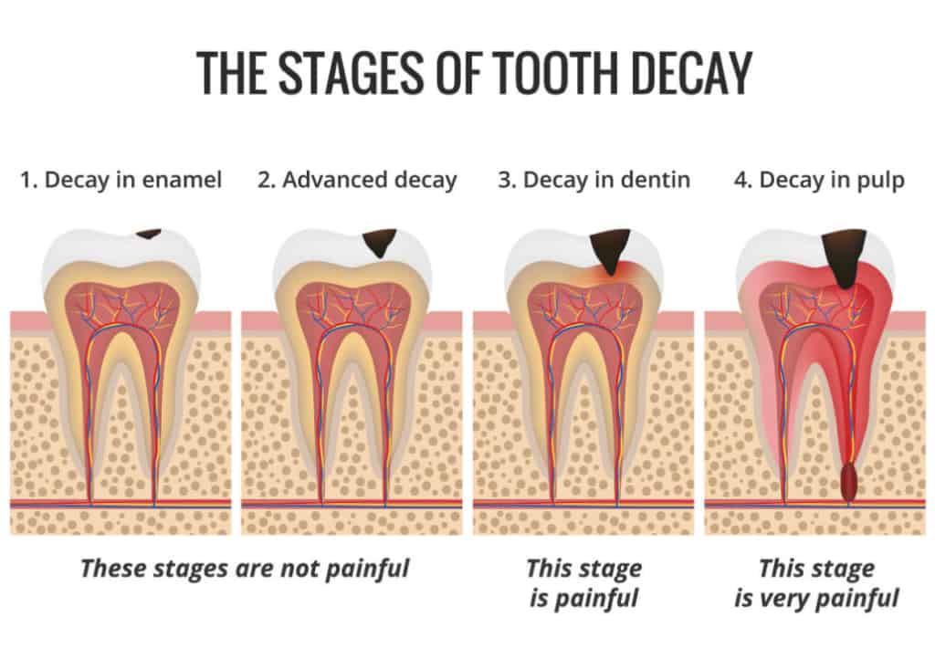 What Do Cavities Look Like Before The Treatment