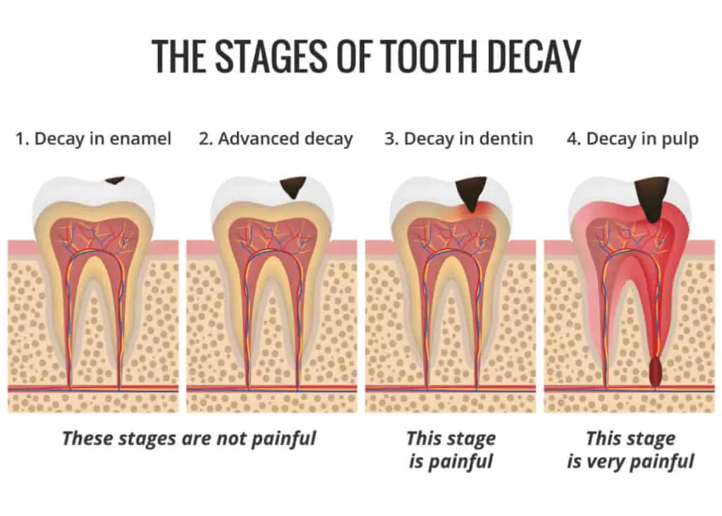 Stages of a cavity and tooth decay.